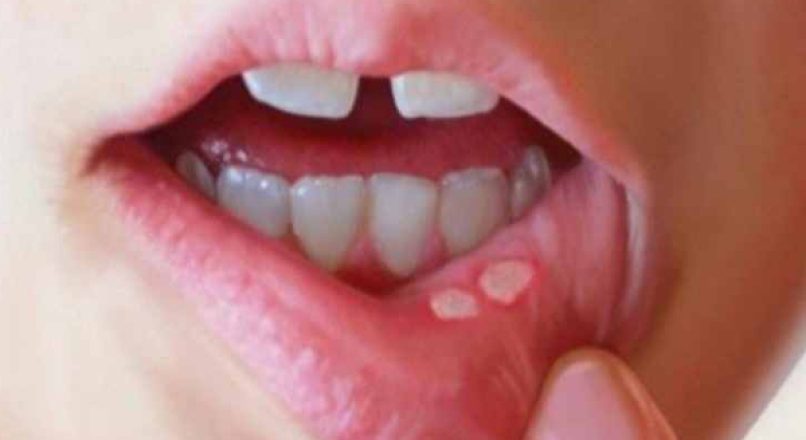 Home remedies for mouth ulcer വായ്പുണ്ണിനുള്ള ഒറ്റമൂലികൾ vaypunninulla ottamoolikal