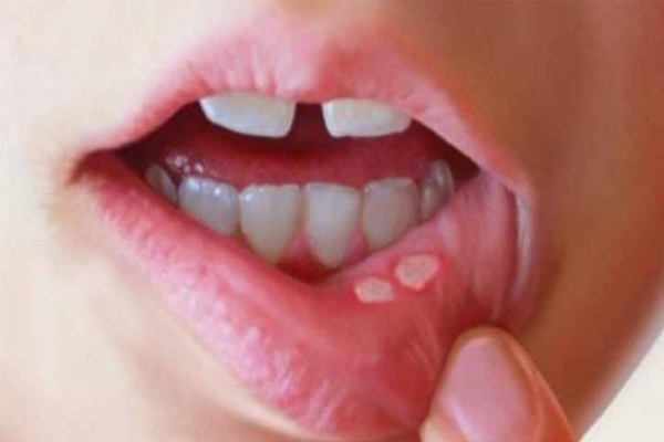 Home remedies for mouth ulcer വായ്പുണ്ണിനുള്ള ഒറ്റമൂലികൾ vaypunninulla ottamoolikal