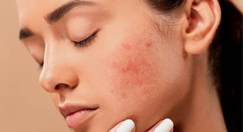 Home remedies for pimples – മുഖക്കുരു മാറാനുള്ള ഒറ്റമൂലികൾ