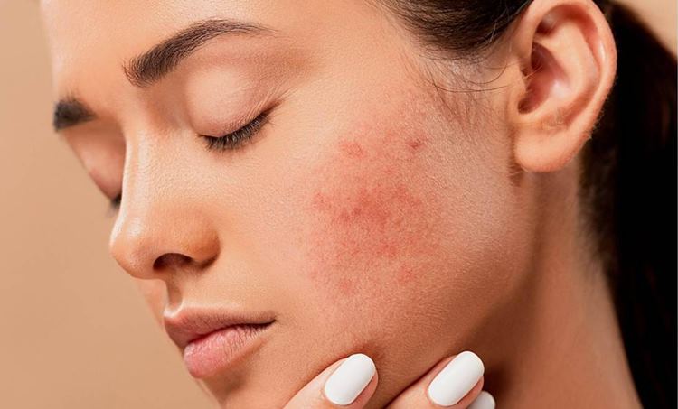 Home remedies for pimples - മുഖക്കുരു മാറാനുള്ള ഒറ്റമൂലികൾ