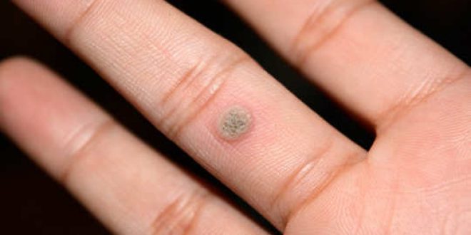 Home Remedies For Skin Warts അരിമ്പാറക്കുള്ള ഒറ്റമൂലി 6487