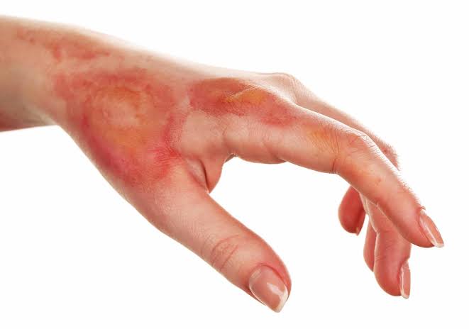 Home Remedies for Burns 