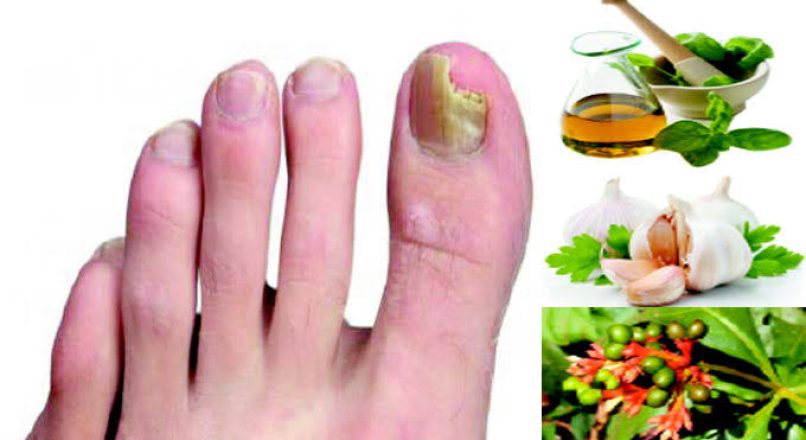 Home Remedies for Nail Fungal Infection – കുഴിനഖം മാറാനുള്ള ഒറ്റമൂലികൾ – Kuzhinakham Maaranulla Ottamoolikal