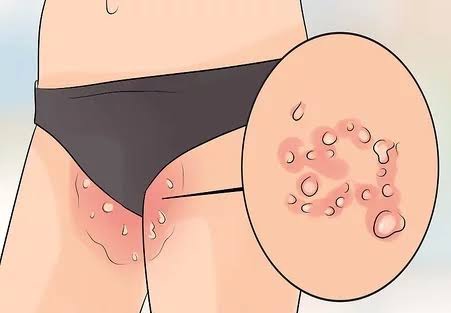 Home Remedies for Jock Itch