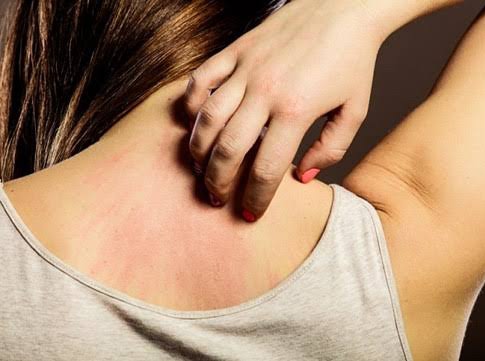 Home Remedies for Itchy Skin