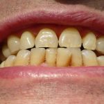 പല്ലിലെ കറ കളയാനുള്ള ഒറ്റമൂലി | Home Remedies for Dental Plaques