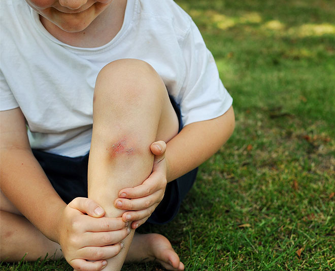 Home Remedies for Bruises