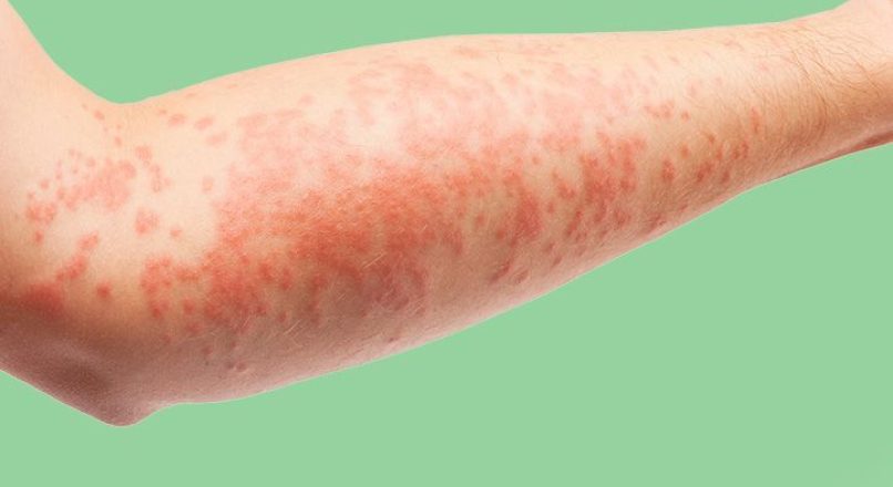 വിസർപ്പം മാറാനുള്ള ഒറ്റമൂലികൾ – Home Remedies for Eczema – Visarppam Maaraanulla Ottamoolikal