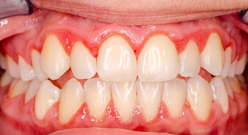 മോണരോഗം മാറാനുള്ള ഒറ്റമൂലികൾ – Home Remedies for Gum Disease – Monarogam Maaranulla Ottamoolikal