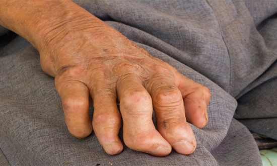 Home Remedies for Leprosy